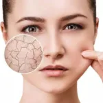 Read more about the article Difference between dry and dehydrated skin