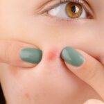 Read more about the article How to get rid of pimples overnight fast