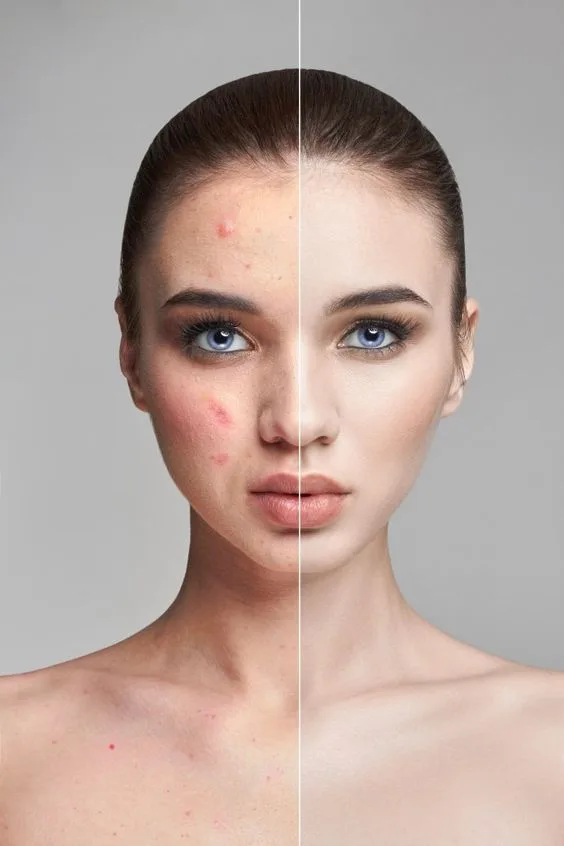 Read more about the article How to control skin Acne