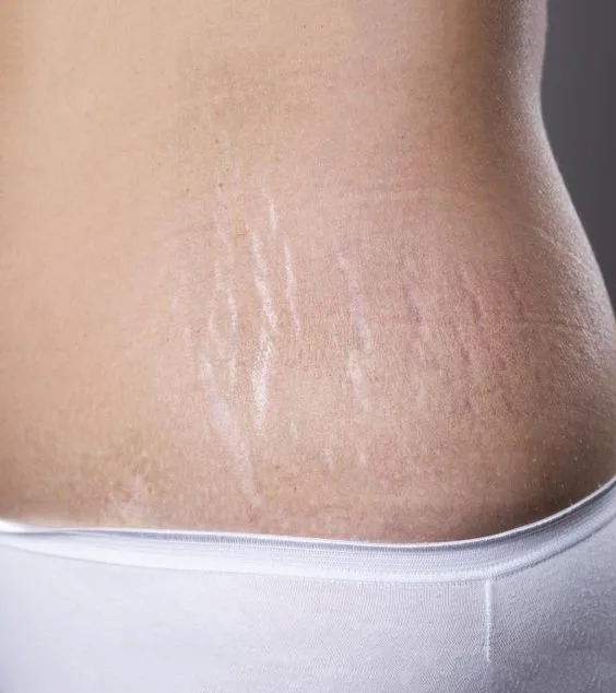 Read more about the article How to get rid of stretch marks?