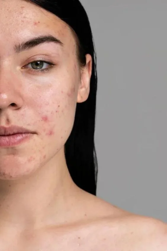 Read more about the article Can certain foods cause acne?
